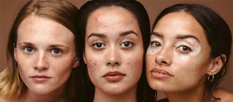 Top 7 Acne Supplements to Treat and Calm Acne